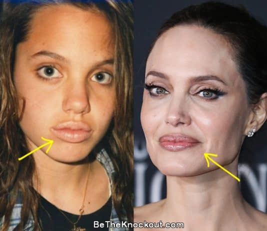 Angelina Jolie lip fillers before and after comparison photo
