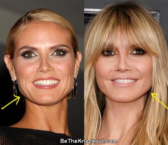 Heidi Klum facelift before and after photo