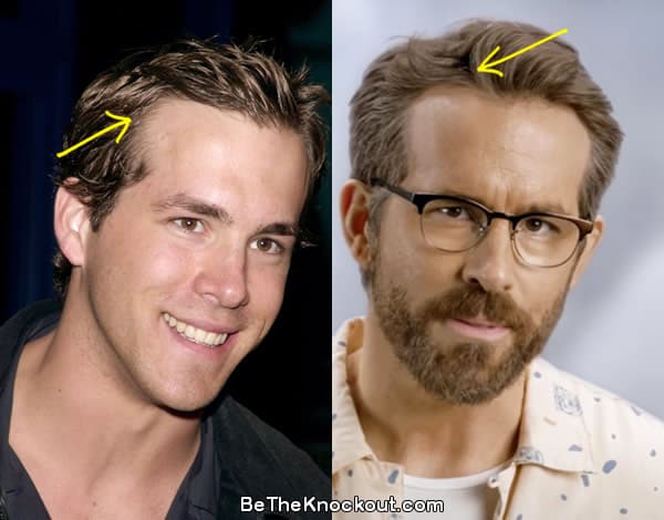 Ryan Reynjolds hair transplant before and after comparison photo