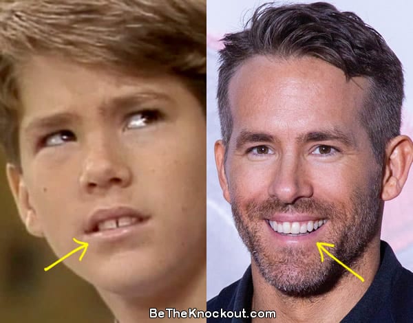 Ryan Reynolds teeth before and after comparison photo