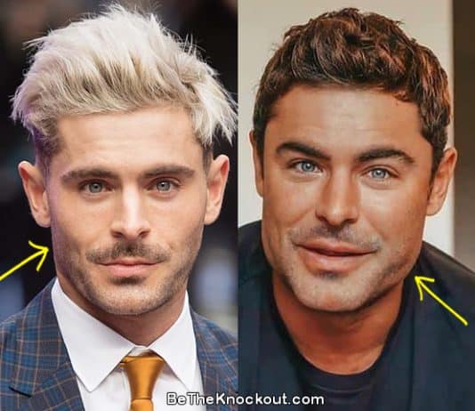 Zac Efron botox before and after comparison photo
