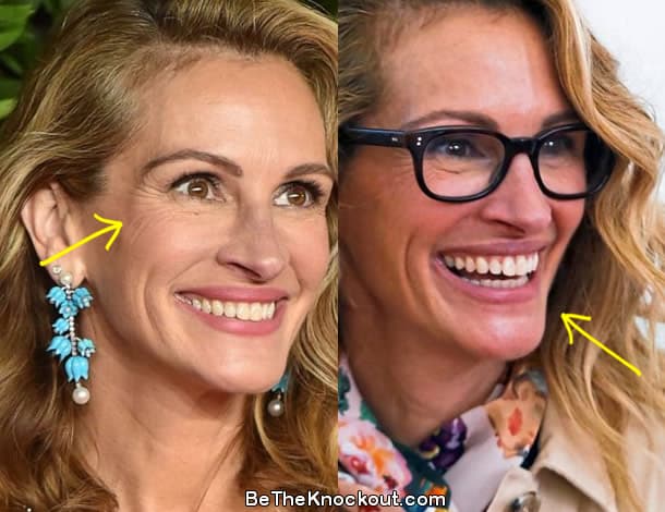 Julia Roberts botox before and after comparison photo