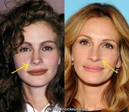 Julia Roberts nose job before and after comparison photo