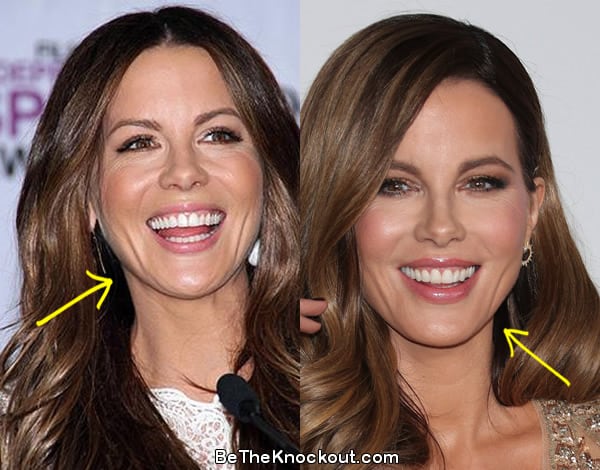 Kate Beckinsale botox before and after comparison photo