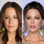 Kate Beckinsale facelift before and after comparison photo