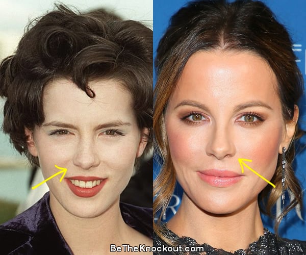Kate Beckinsale nose job before and after comparison photo