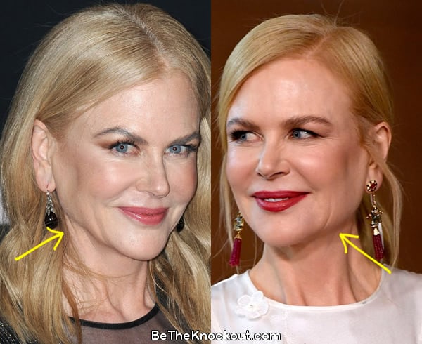 Nicole Kidman facelift before and after comparison photo
