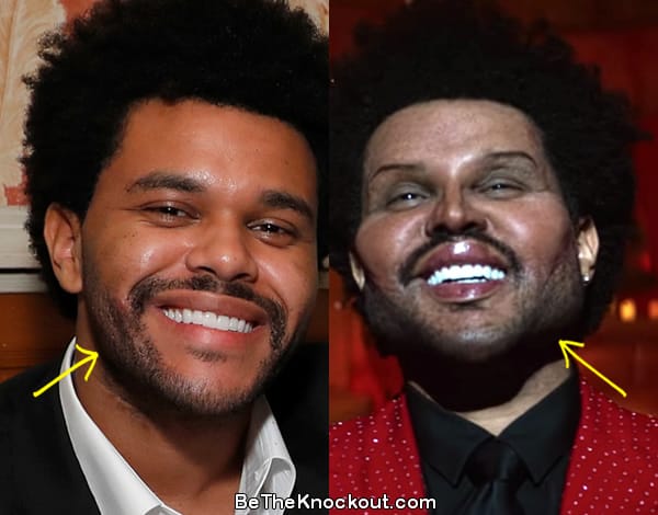 The Weeknd botox before and after comparison photo
