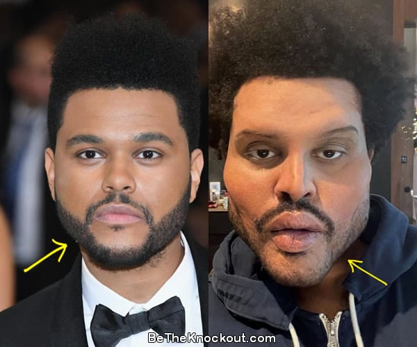 The Weeknd facelift before and after comparison photo