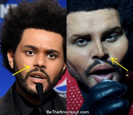 The Weeknd nose job before and after comparison photo