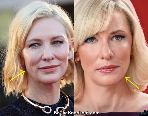 Cate Blanchett facelift before and after comparison photo