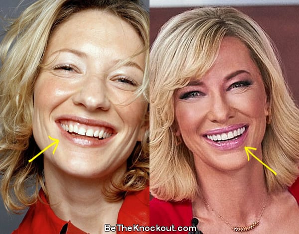 Cate Blanchett teeth before and after comparison photo