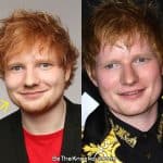 Ed Sheeran botox before and after comparison photo
