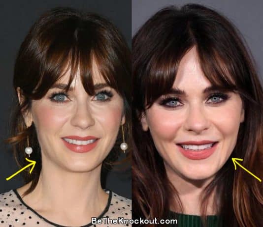 Zooey Deschanel botox before and after comparison photo
